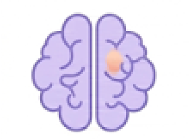 Epilepsia y convulsiones